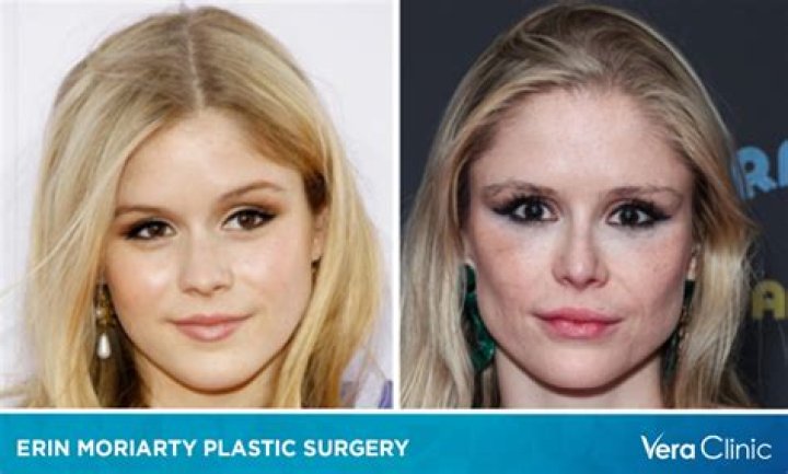 Erin Moriarty Plastic Surgery. The Boy's Annie January Starlight Buccal